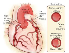 【症状】【冠心病的症状】(图1)