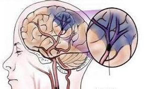 【治疗】治疗急性脑梗塞的方法哪些比较常见(图1)