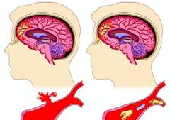 【病因】青年脑血栓的病因?(图1) 【病因】青年脑血栓的病因?(图1)