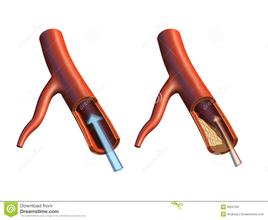 【治疗】下肢动脉硬化闭塞症如何治疗效果好(图1)