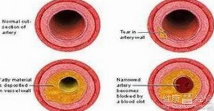 【检查】主动脉硬化如何诊断(图1)