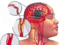 【检查】脑梗塞的诊断和检查(图1)