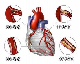 有哪些措施预防冠心病呢(图1) 有哪些措施预防冠心病呢(图1)
