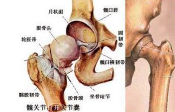 【饮食】股骨头坏死饮食注意什么(图1)