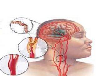 【饮食】脑血管硬化的症状和饮食治疗(图1) 【饮食】脑血管硬化的症状和饮食治疗(图1)