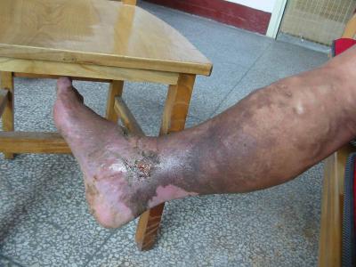 你知道怎么预防老烂腿吗？(图1)